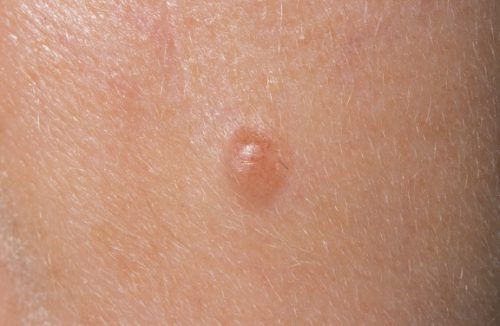 Proč se krtky staly konvexními a co dělat?